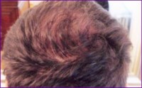 After 2nd hair restoration